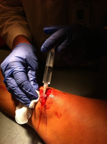 This is the part that actually did hurt. Pushing the numbing solution into my knee. 